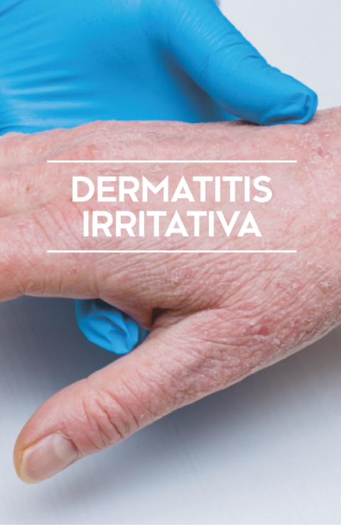 Dermatitis-Irritativa_Portada BBlog_storie1